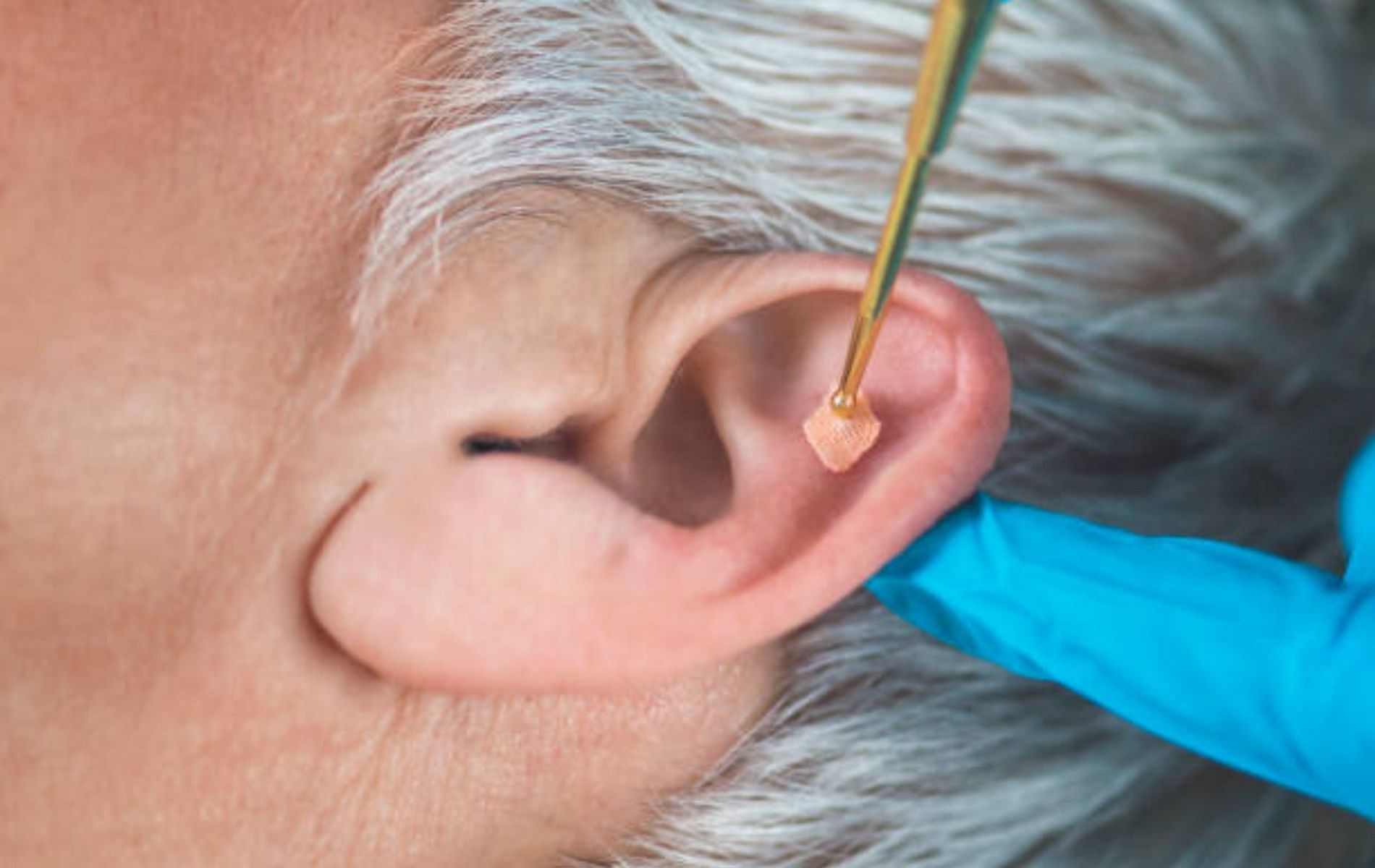 Ear seeds can help with weight loss. (Image via iStockphoto)