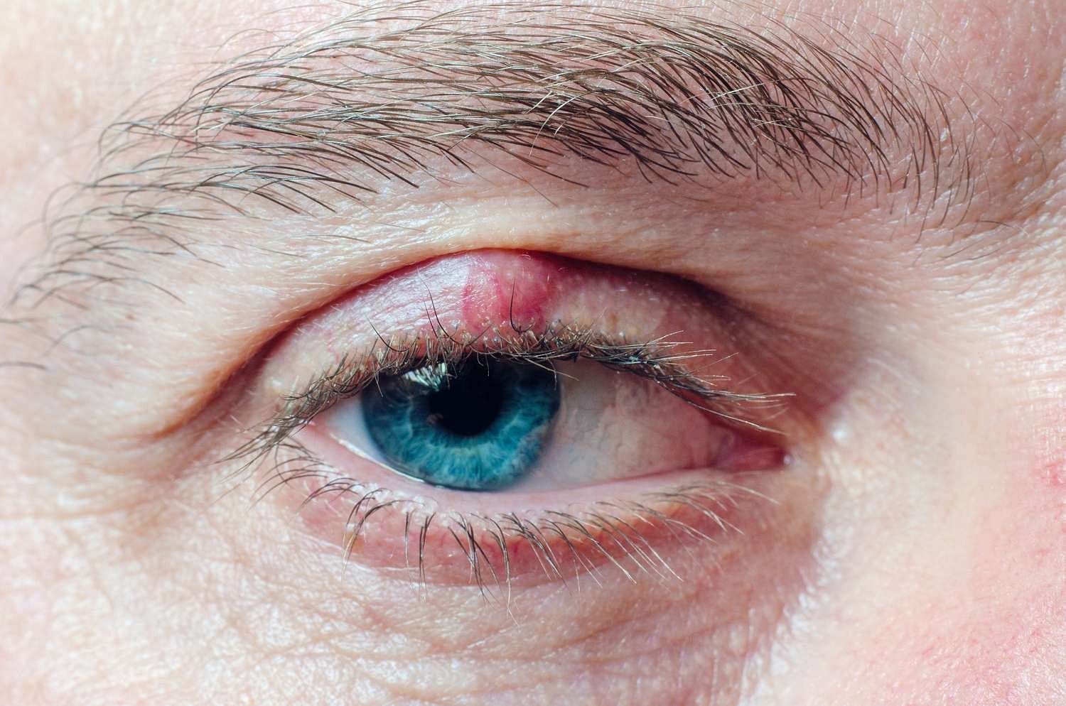 Do You Have Chalazion? Here’s How to Get Rid of It