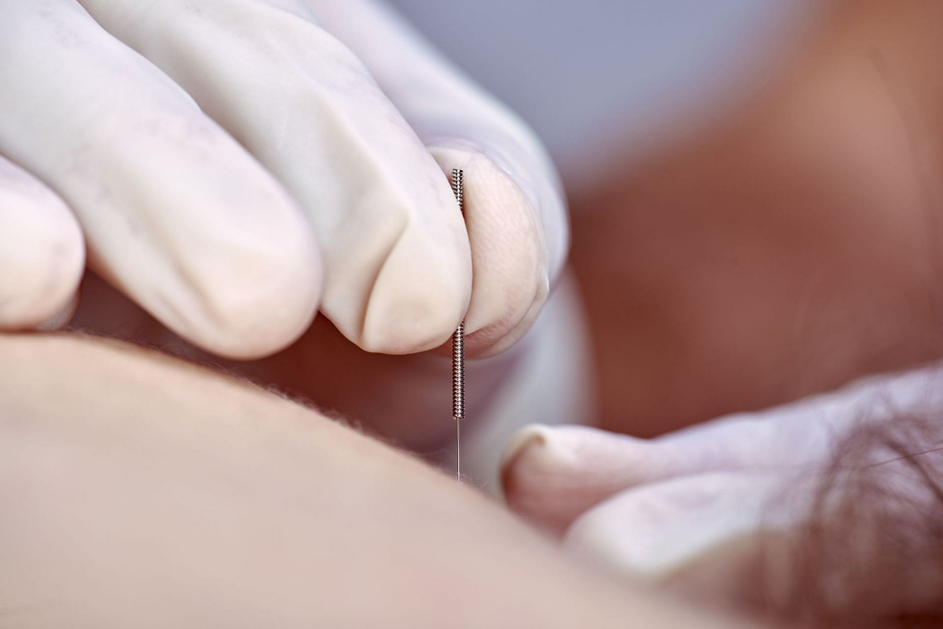 Dry needling vs. acupuncture (Image via Getty Images/ Sunlight19)
