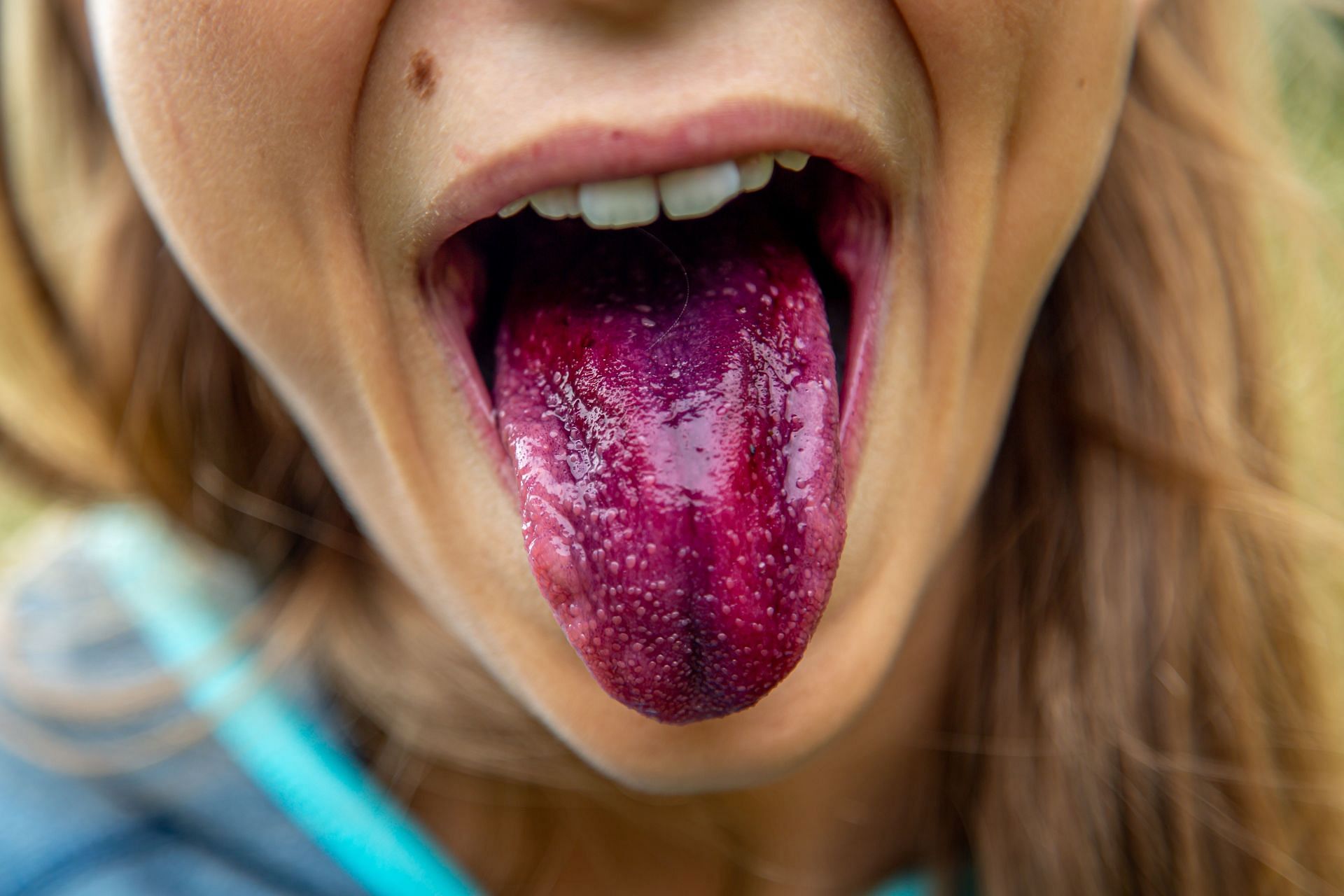An inflamed tongue is one of the major signs of B6 deficiency. (Image via Unsplash/Alex Guillaume)