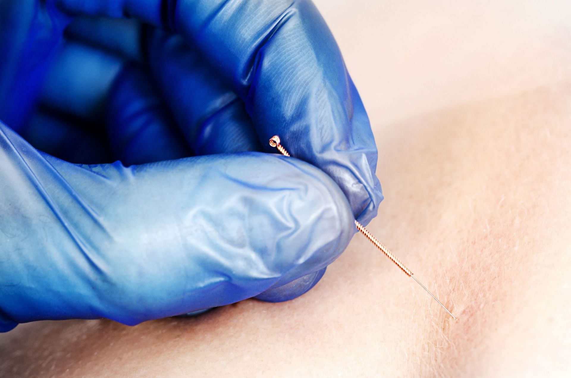 Dry needling vs. acupuncture (Image via Getty Images/ Sunlight19)