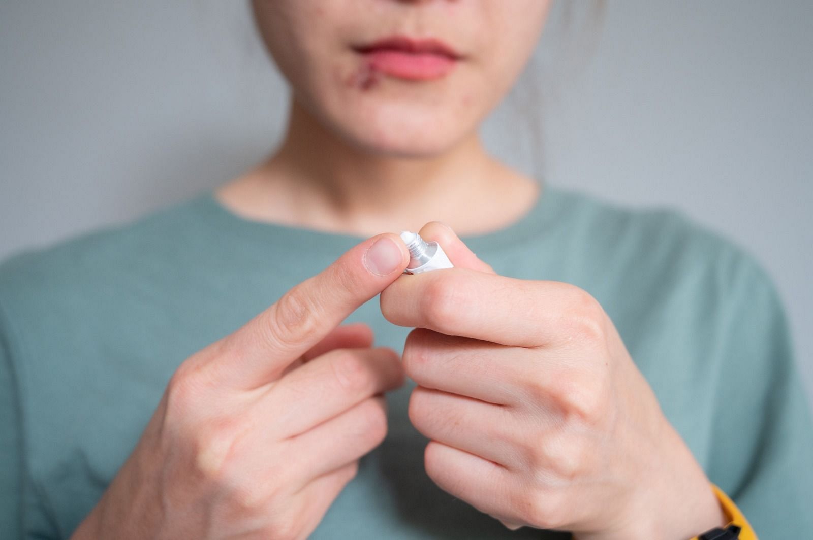 Cold sore and pimple (Image via BOY_ANUPONG/Getty Images)