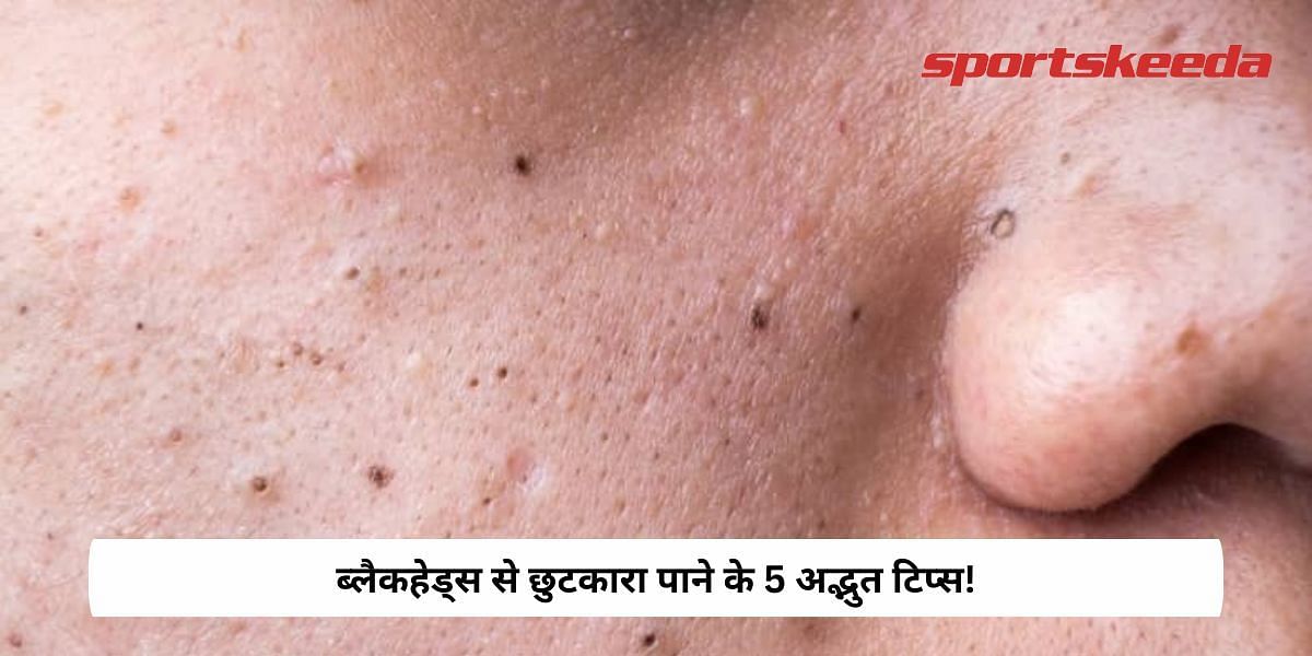 5 Amazing Tips to get rid of blackheads!
