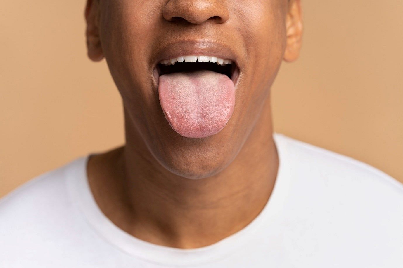 pimples-on-tongue-what-does-it-indicate-and-how-to-treat-it