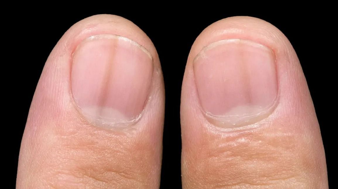 Nail artist raises awareness of a symptom of skin cancer most people don't  notice | Metro News