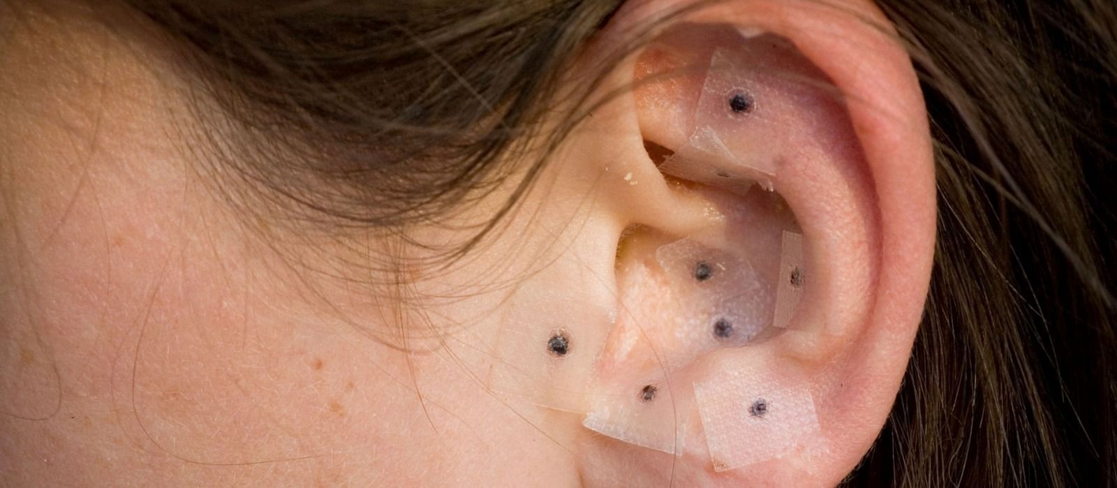 Ear-Seeding (Image via McGill)