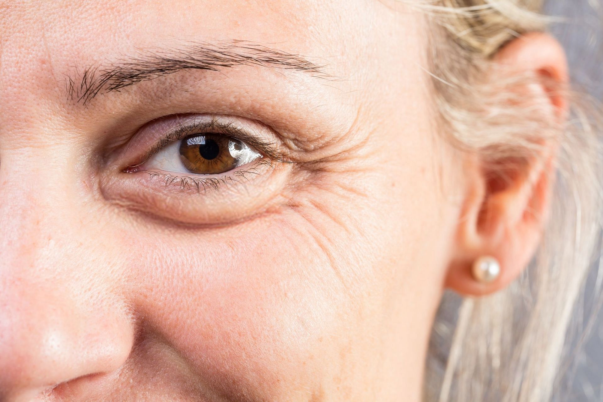 Sunken-eyes (Image via Getty Images/Wirestock)