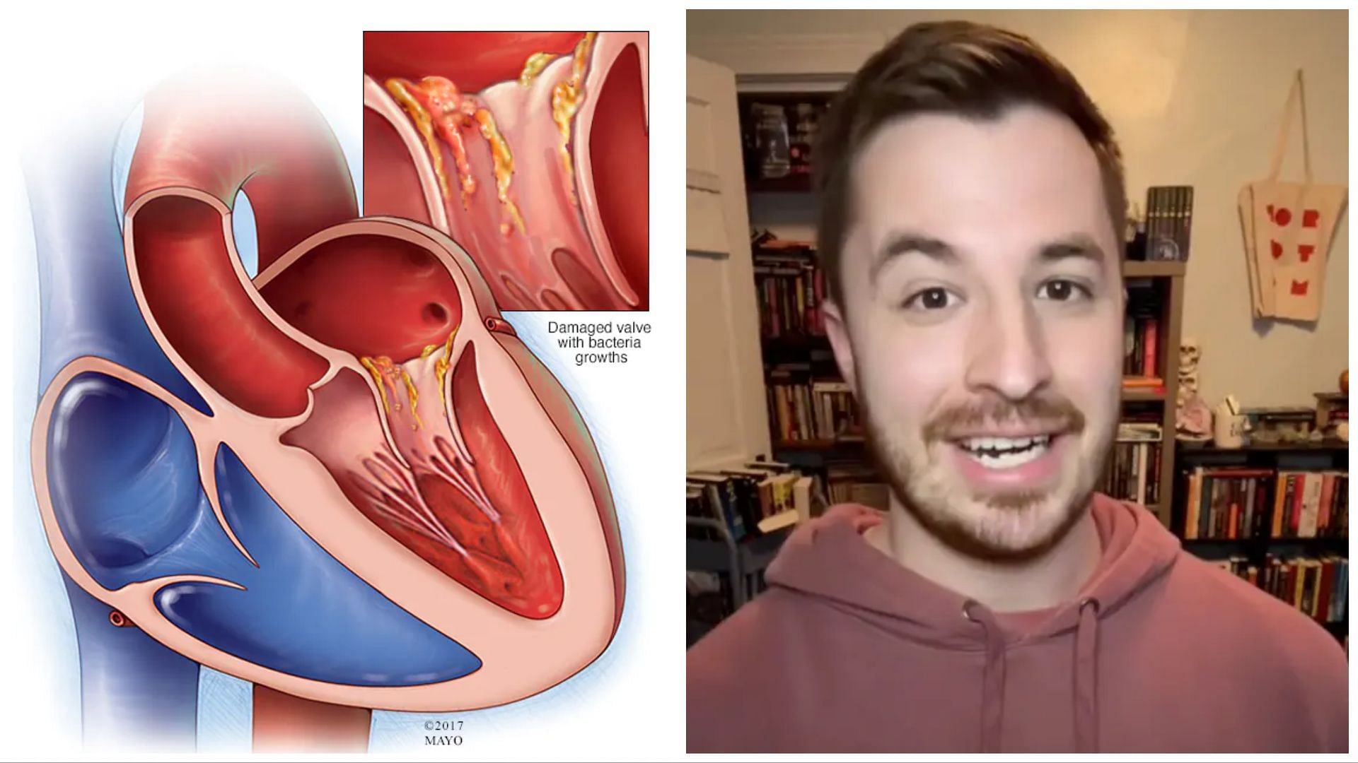 Brandon Baker was diagnosed with Bacterial Endocarditis (Image via Mayo clinic / Tiktok / @baker.reads)