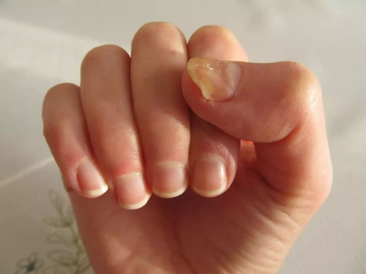 There are ways to avoid discolored nails (Image via Instagram/not_a_google_doctor)