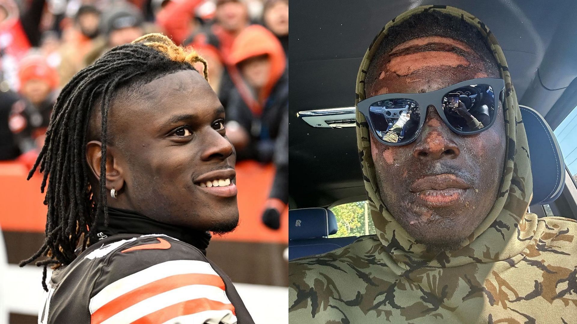 How did David Njoku burn his face? Browns star shows extent of facial  burns, NFL fans laud bravery