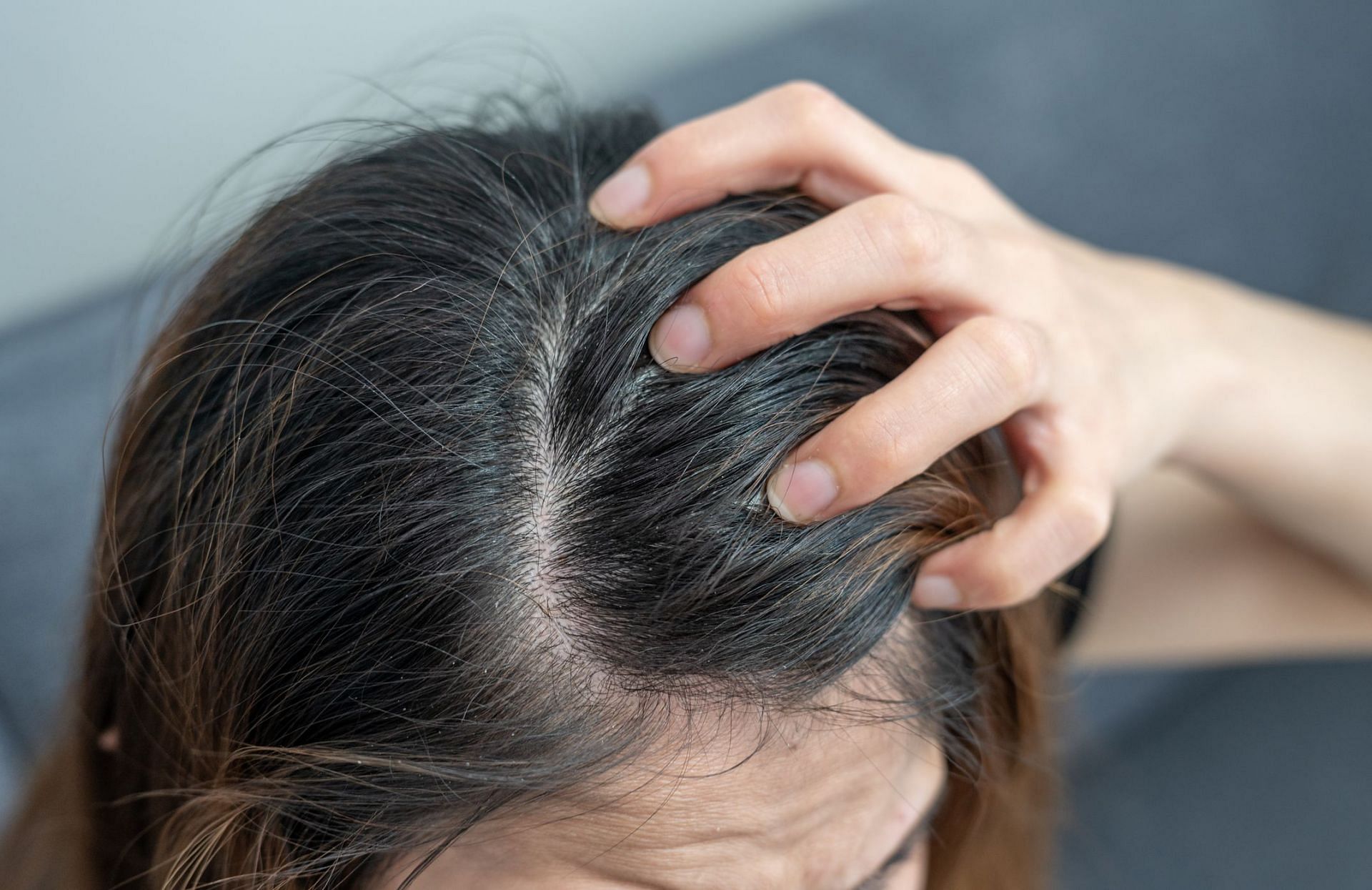 Dandruff in winter (Image via Getty Images/Boy_Anupong)