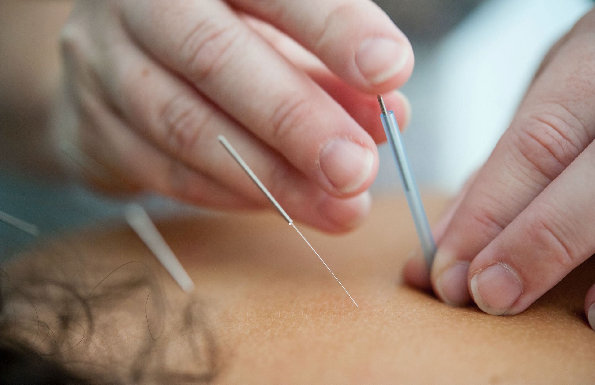 Acupuncture for migraines (Image via Unsplash/Katherine Hanlon)