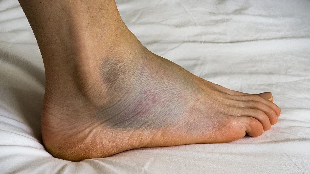 Swollen Feet (Image via Dr Kumo)