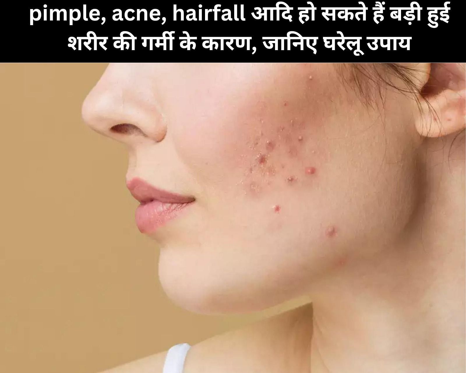 pimple, acne, hairfall आदि हो सकते हैं बड़ी हुई शरीर की गर्मी के कारण, जानिए 15 घरेलू उपाय (फोटो - sportskeedaहिन्दी)
