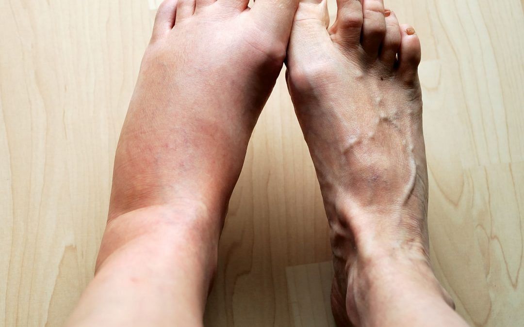Swollen Feet (Image via Dr Kumo)