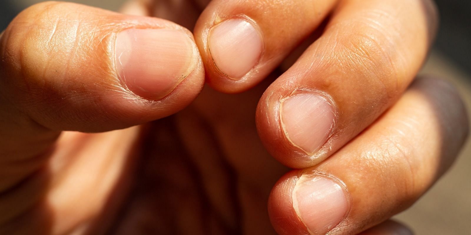 There are several health issues behind discolored nails (Image via Instagram/hey_miss_medico)