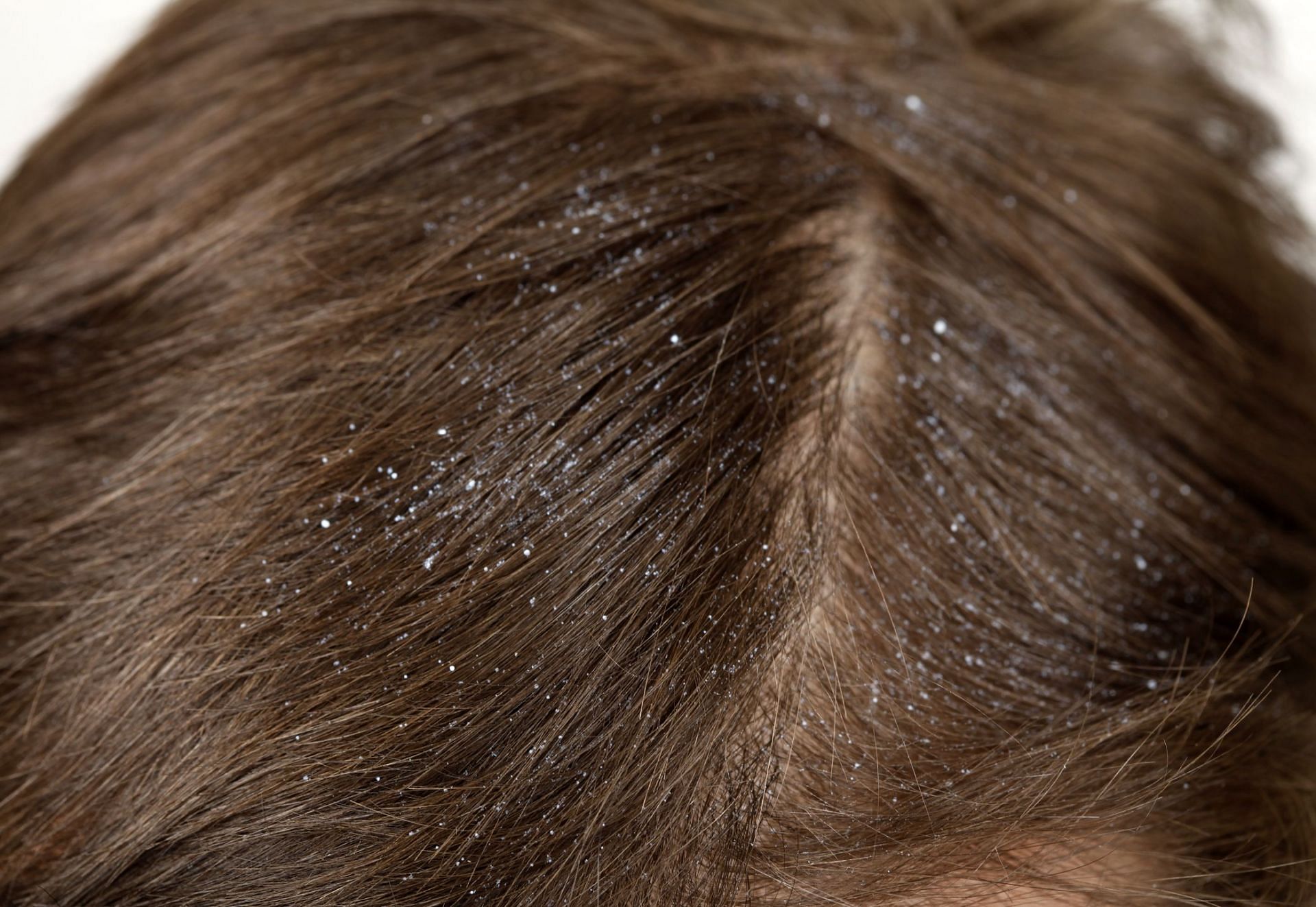Dandruff in winter (Image via Getty Images/Boy_Anupong)