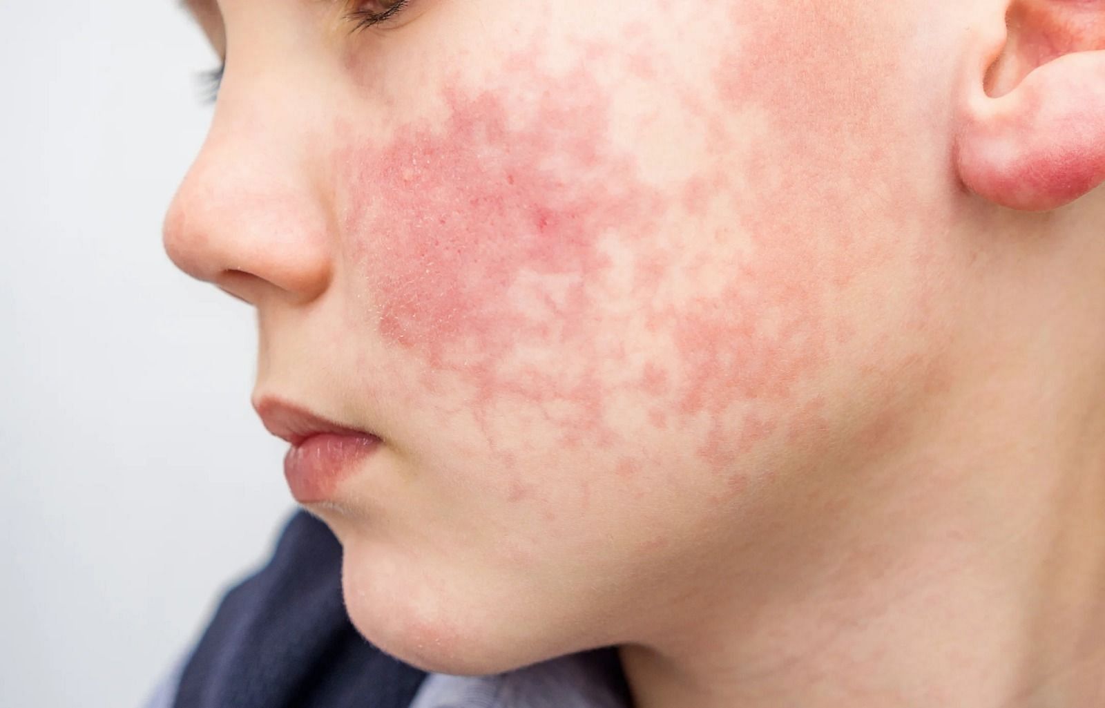 Heat rash on face (Image via Evgen_Prozhyrko/ Getty Images)