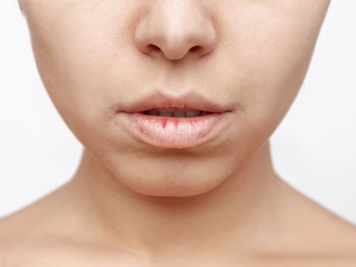 Chapped lips (Image via Freepik)