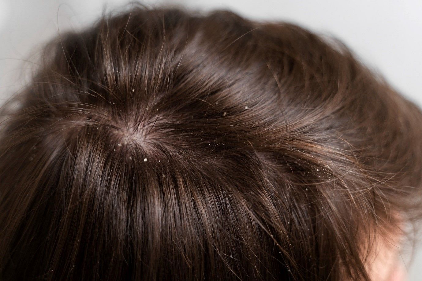 To have a hydrated scalp, one should use at-home treatments (image by freepik on freepik)