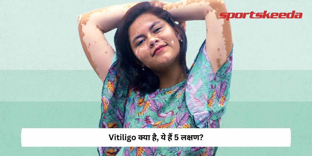 What Is Vitiligo, here are the 5 symptoms!