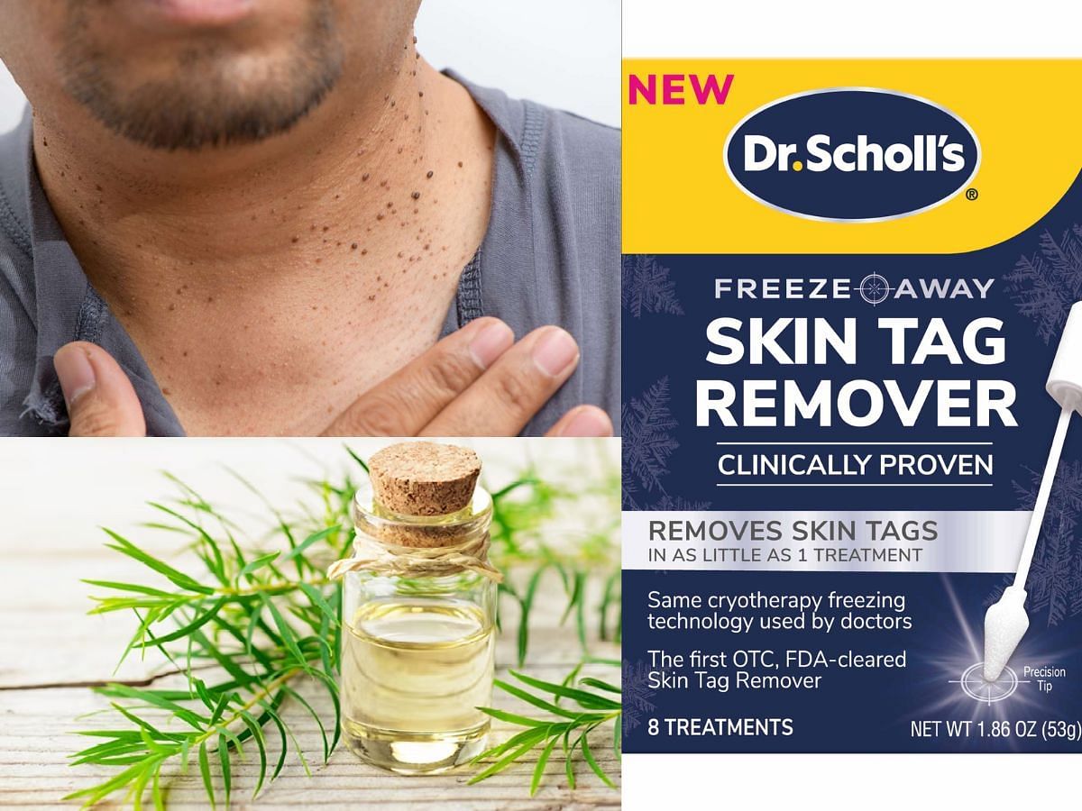 Skin Tag Remover Removes Skin Tags in as Little as 1 Treatment