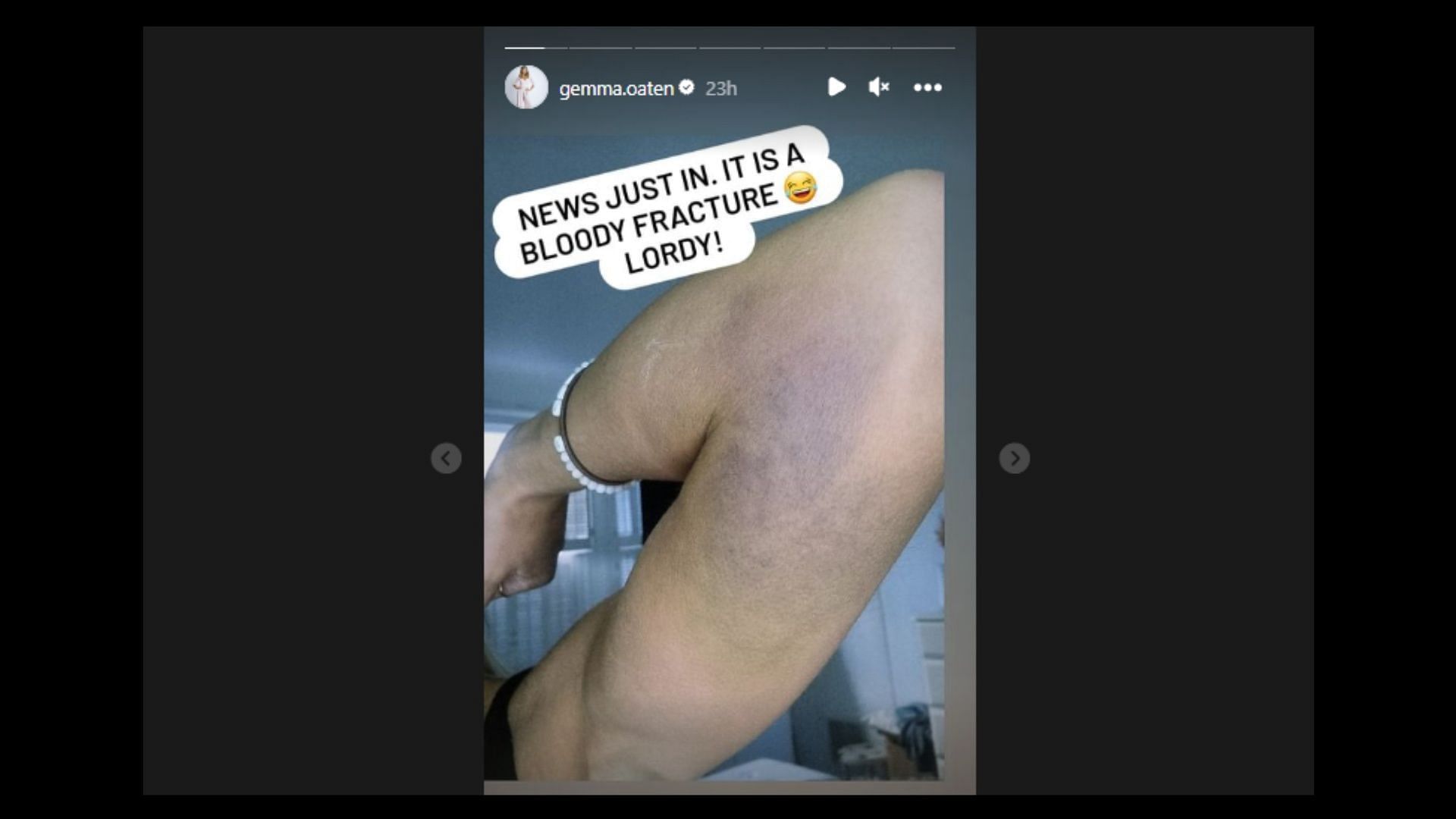 Gemma shows her injured elbow (Image via gemma.oaten/Instagram)