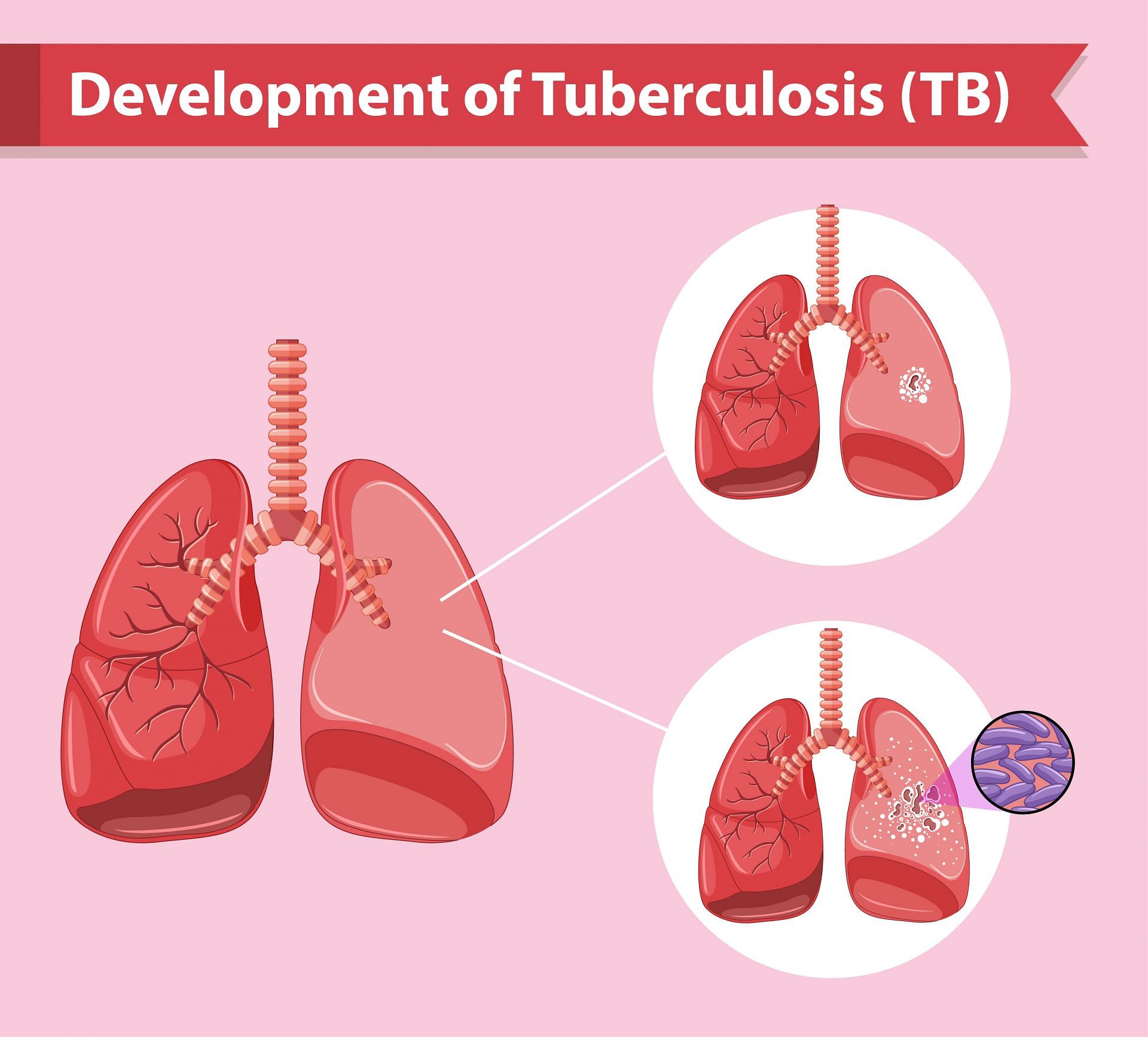 In 2022 at least 10.6 million people were affected by Tuberculosis (Image via freepik)