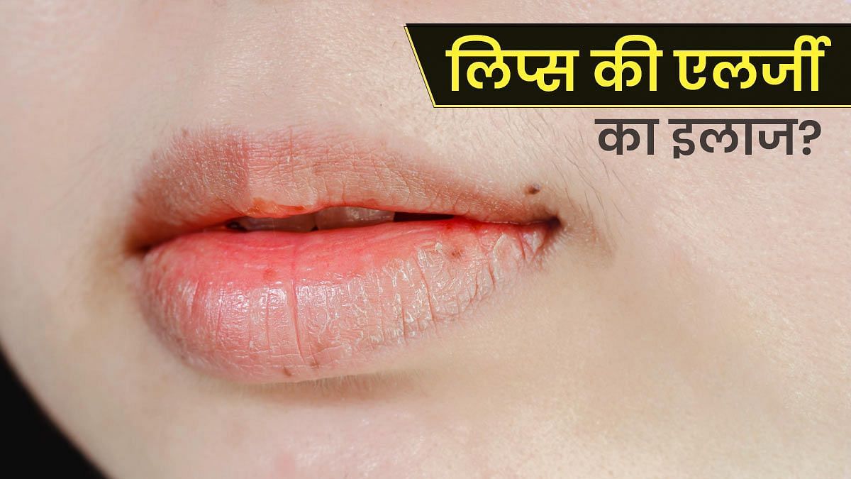 होठों पर एलर्जी का इलाज(sportskeeda Hindi) 
