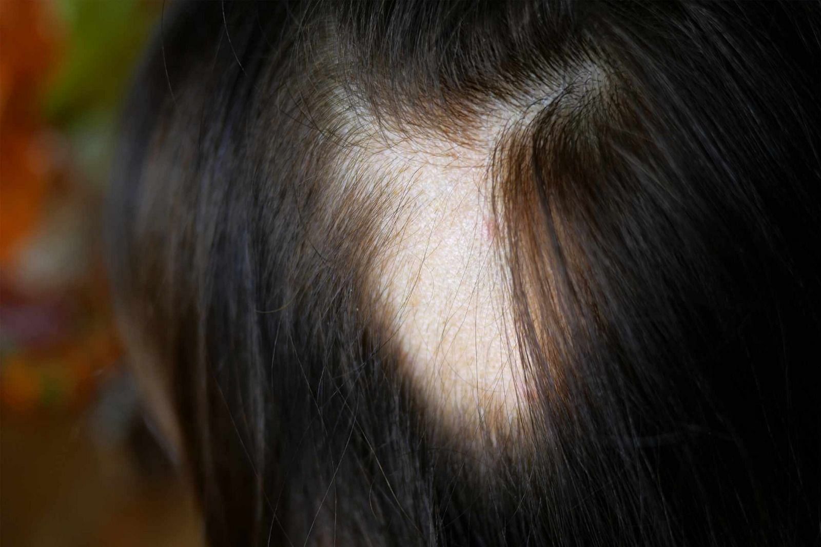 Hair loss (Image via Getty Images)