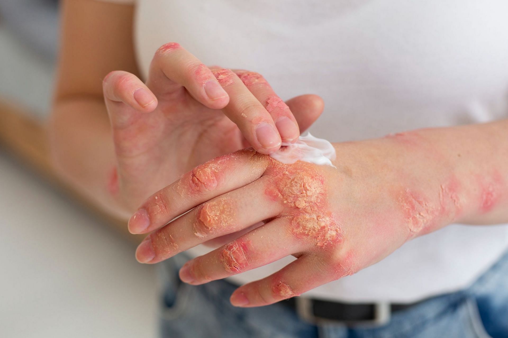 Several types of fungal infections can occur on the skin. (Image via Freepik)