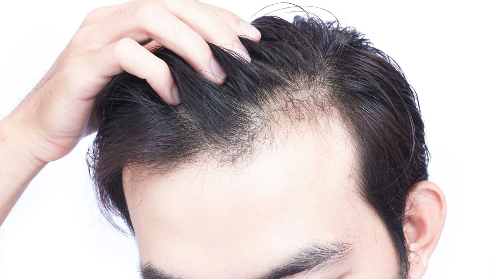 Hair shed in winter (Image via Getty Images)