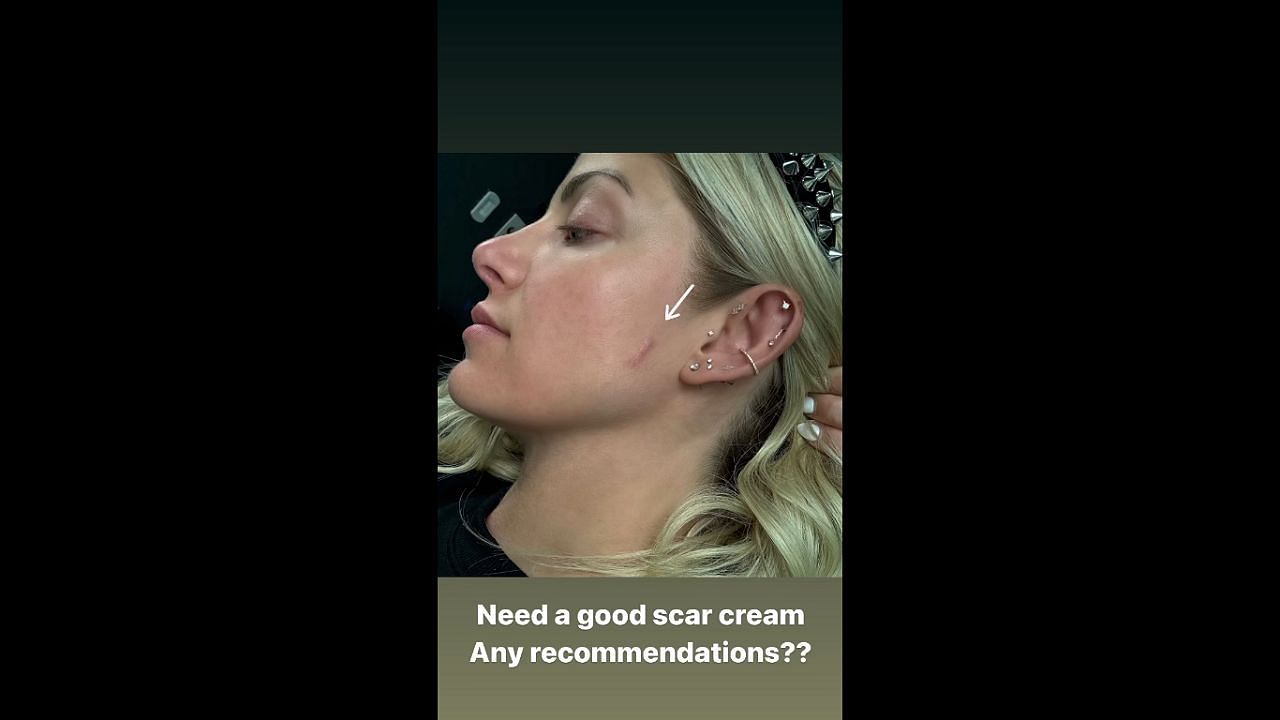 Alexa Bliss shows off her scar