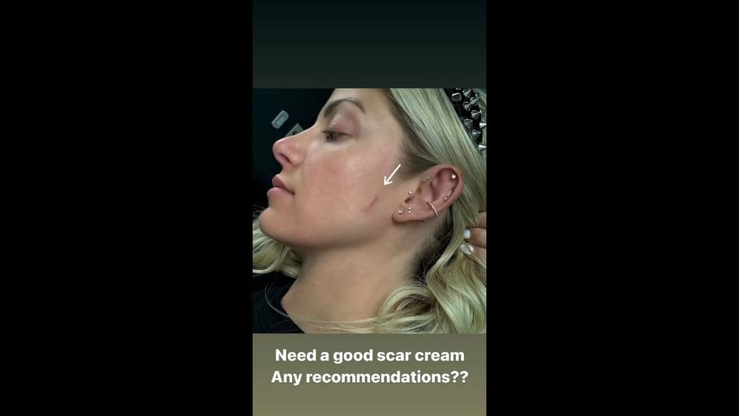 Alexa Bliss shows off her scar; has a request for fans