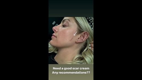 Alexa Bliss shows off her scar