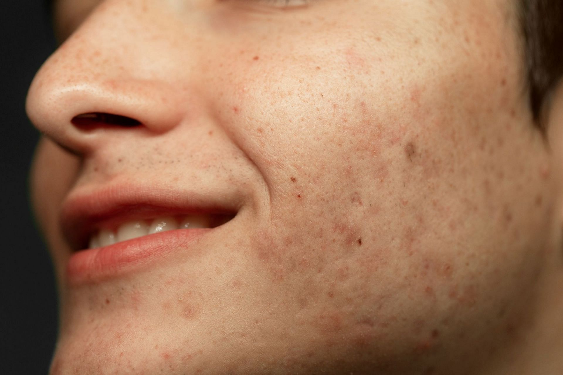 Open pores arise due to the overproduction of sebum by the body&#039;s sebaceous glands (Image via freepik)