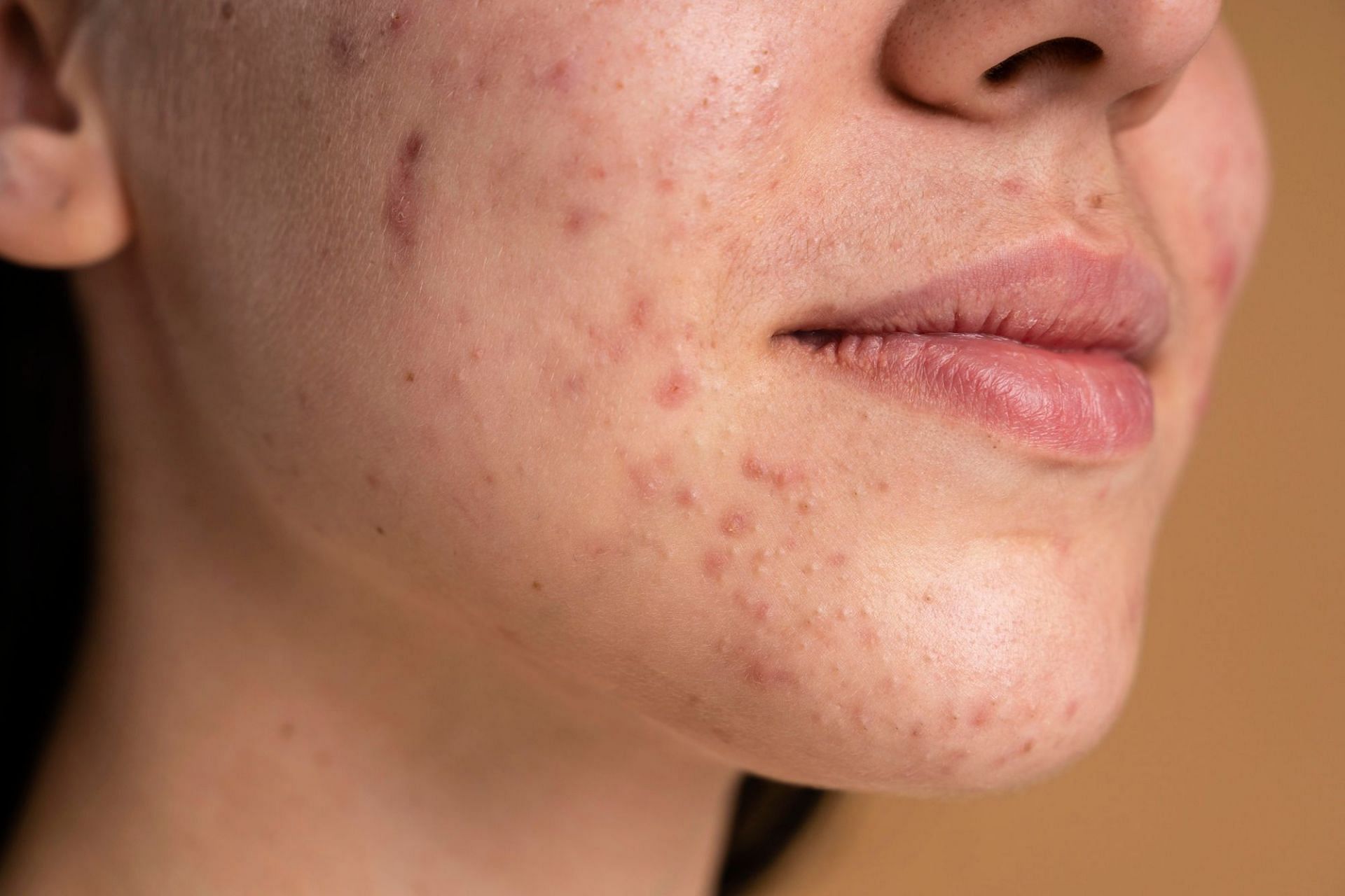 Open pores can be dealt with in a number of ways, some of which can be practiced at home (Image via freepik)