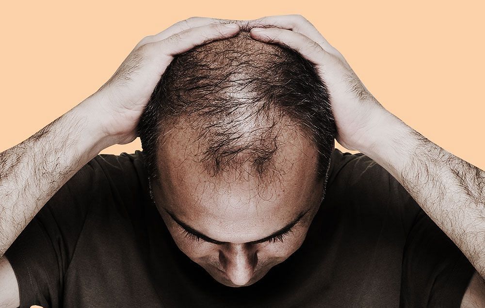 Hair Loss (Image via Getty Images)