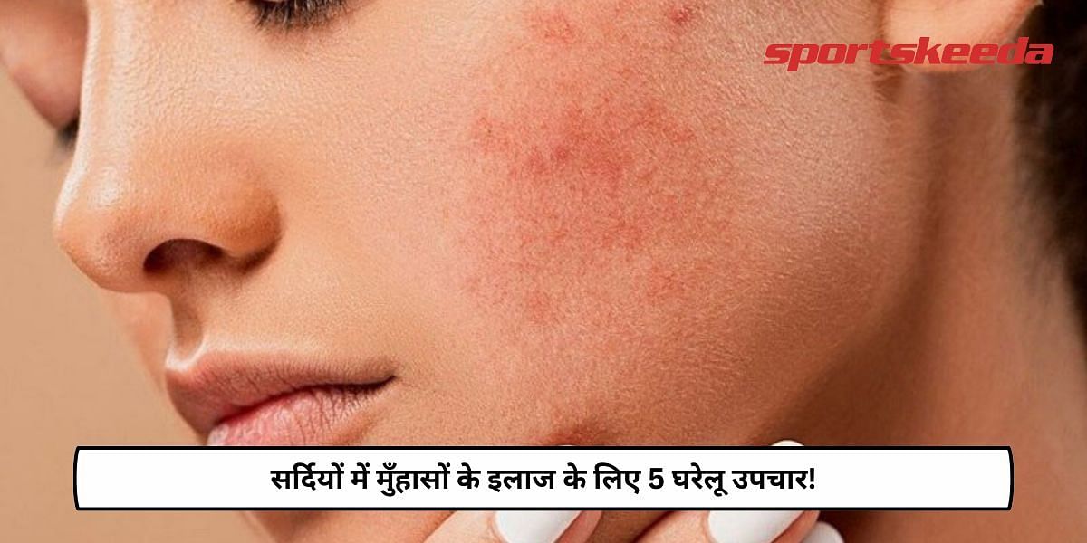 5 Home Remedies To Treat Acne In Winter!