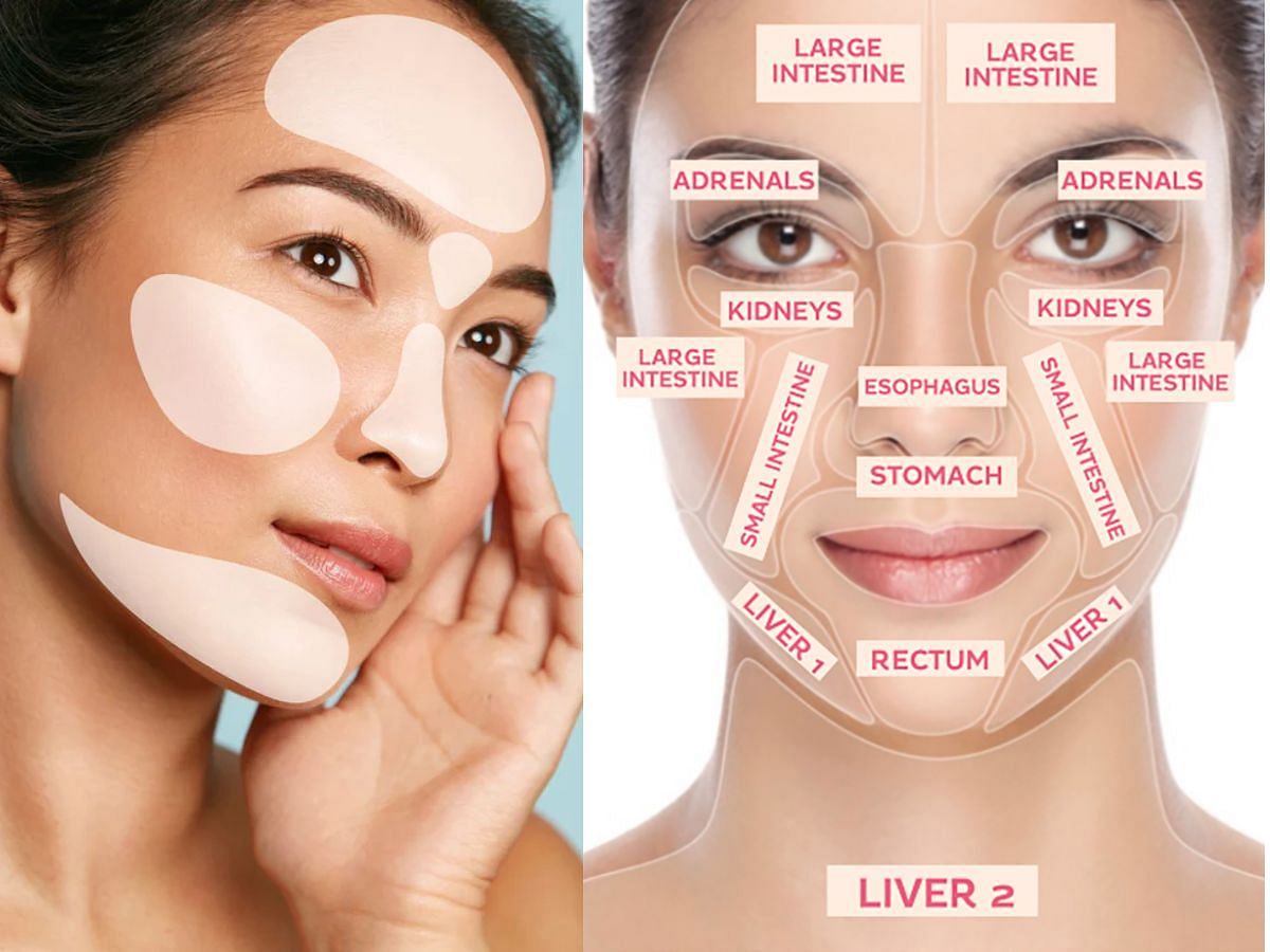 Acne face mapping (Image via Sportskeeda)