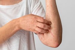 5 Eczema Diet Plans Which Can Be Helpful For Your Skin Issues