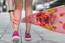 Understanding Blood Clot in the Leg: What are the Common Symptoms and Treatments?