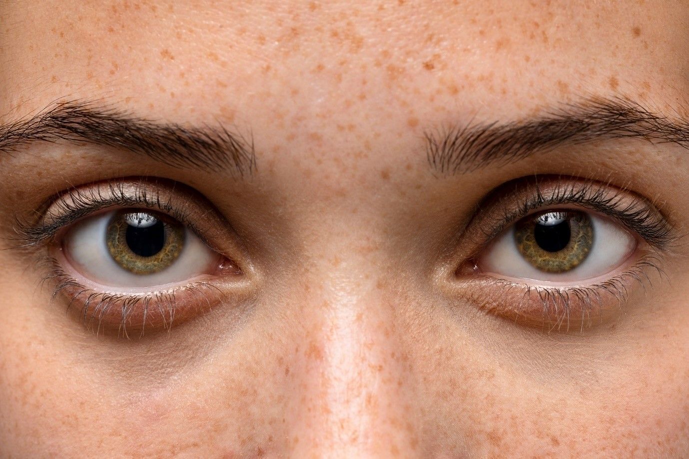 Are freckles some sort of disorder? (image by freepik on freepik)