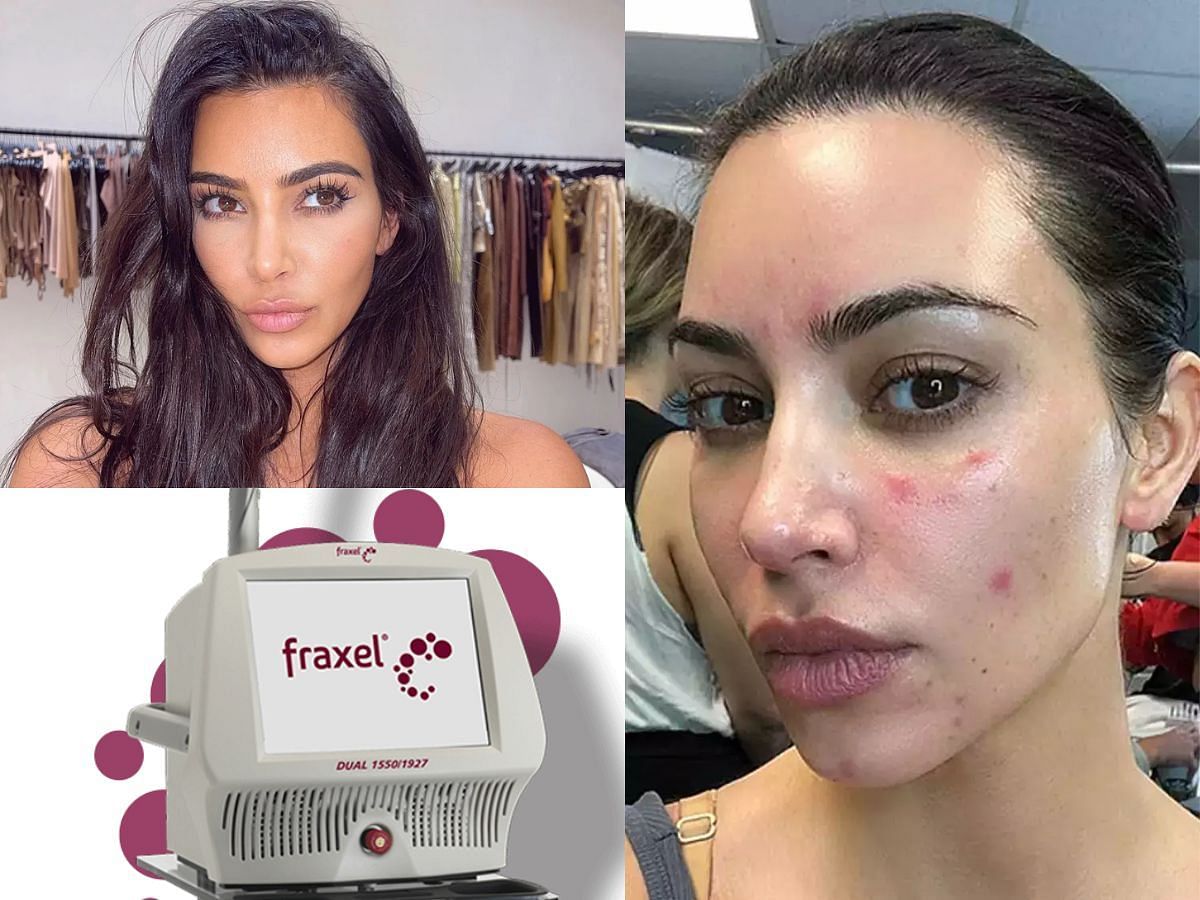 Laser for acne scar removal (Image via Sportskeeda)