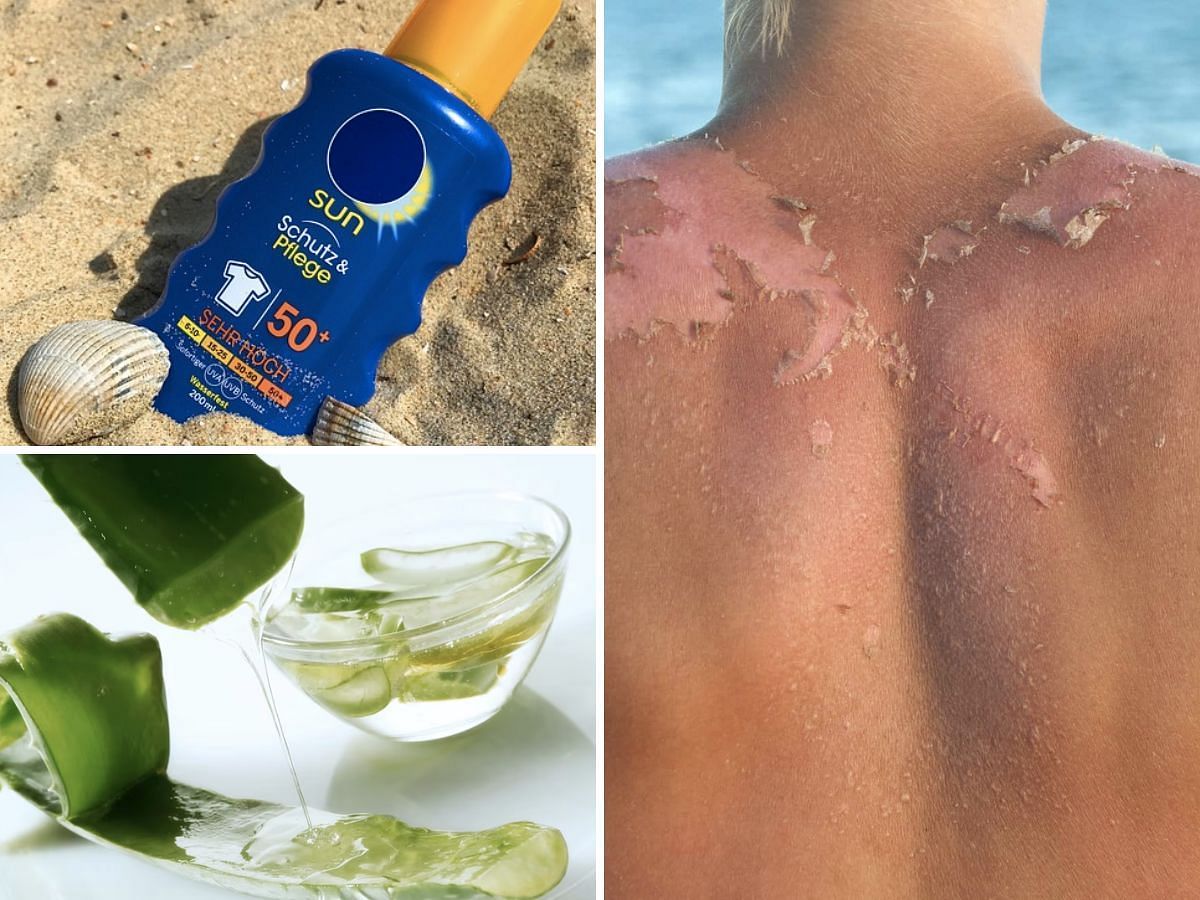 Handling sunburn-induced skin peeling (Image via Sportskeeda)