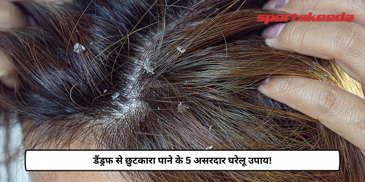 5 Effective Home Remedies To Get Rid Of Dandruff!