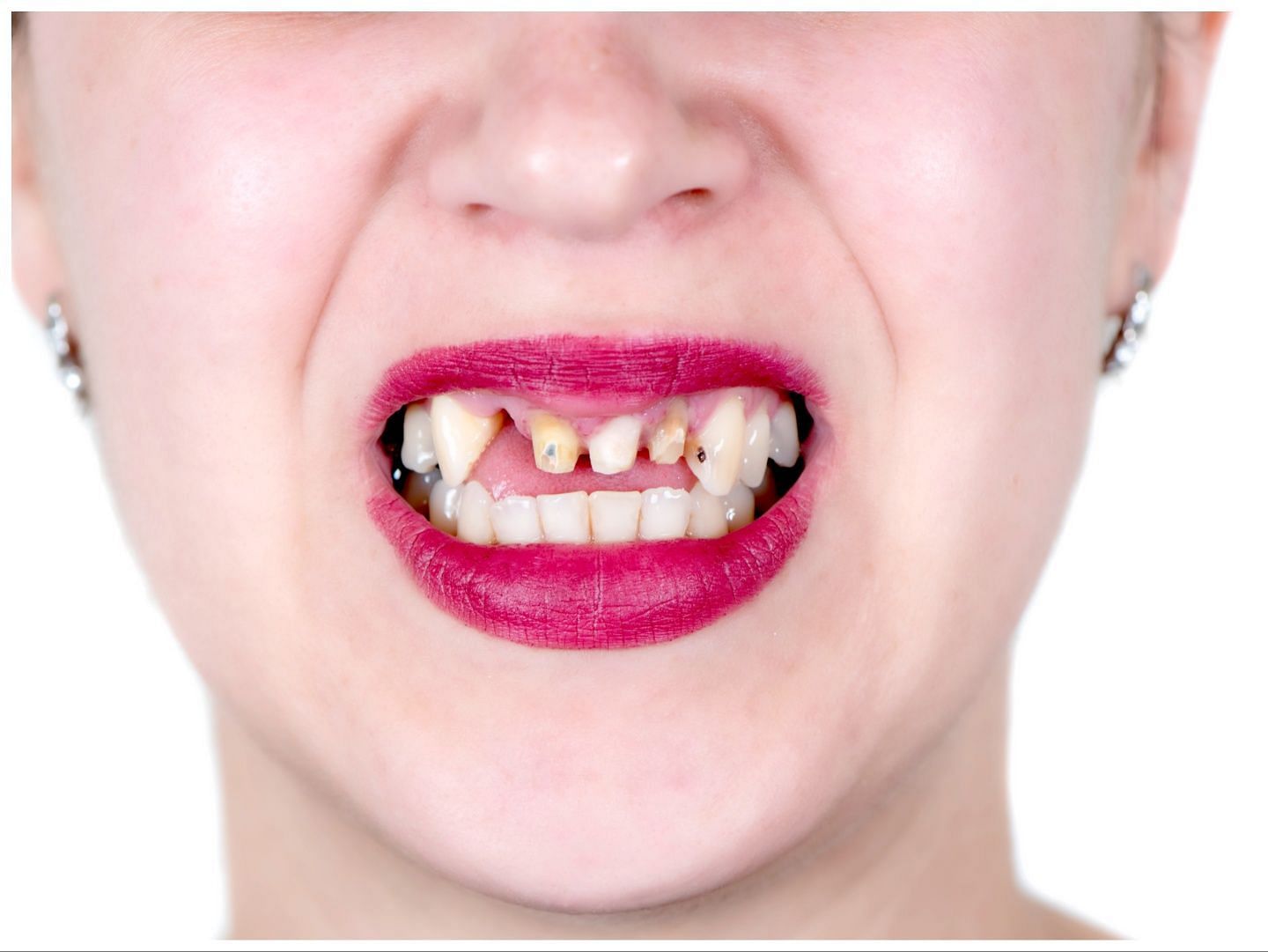 Drinking soda can damage your teeth (Image via Vecteezy)