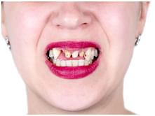 The hidden dangers of drinking soda: are they ruining your teeth?