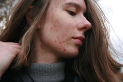 Is Fungal Acne Different from Normal Acne? Yes, and Here's How to Treat Them