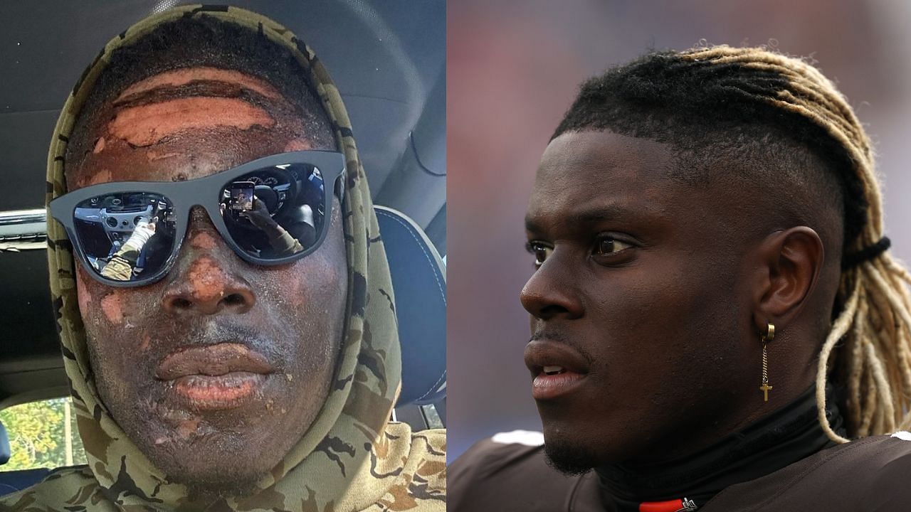 David Njoku suffered massive burns to his hands and face in a fire pit incident early in the 2023-24 season